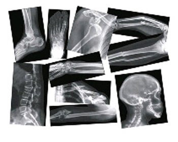 Broken Bones X-Rays  15 pcs