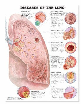 Diseases Of The Lung Anatomical Chart - Laminated