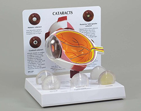 Cataract Eye Anatomy Model