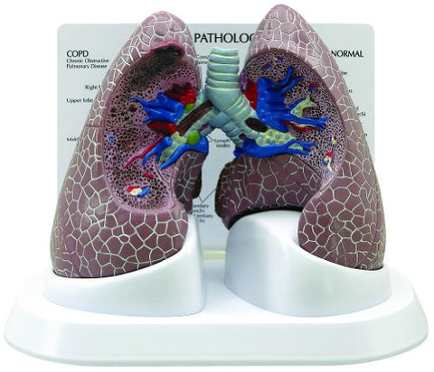 Diseased Lung Anatomy Model